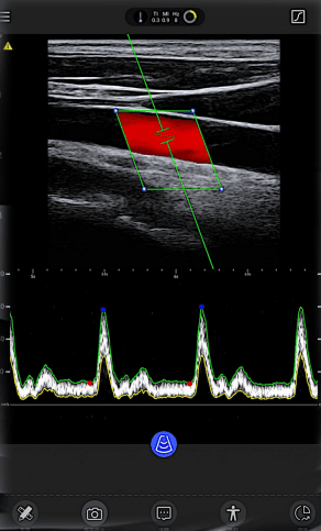 Thyroid RT Lobe with Trapezoid